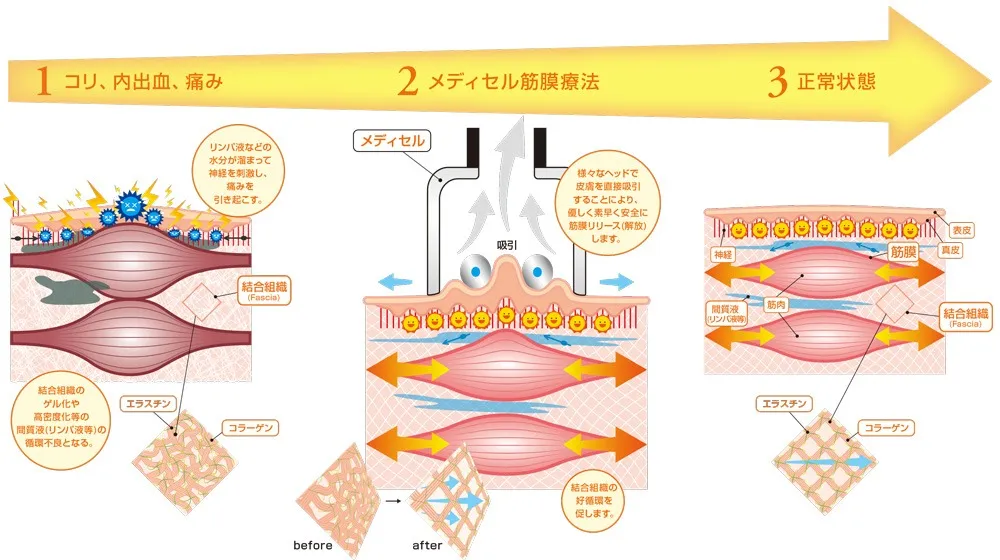 メディセル筋膜療法の流れのイラスト図